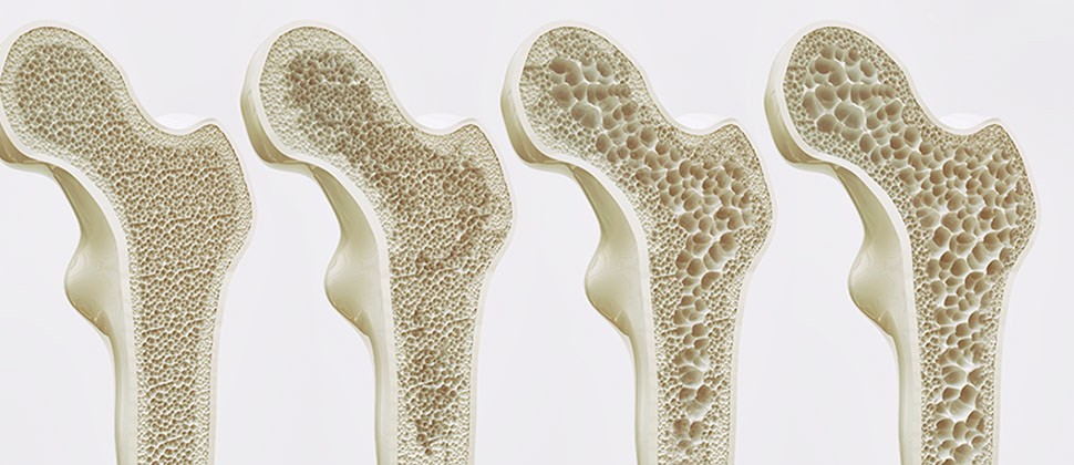 Osteoporosis y el consumo de bebidas de cola con ácido fosfórico