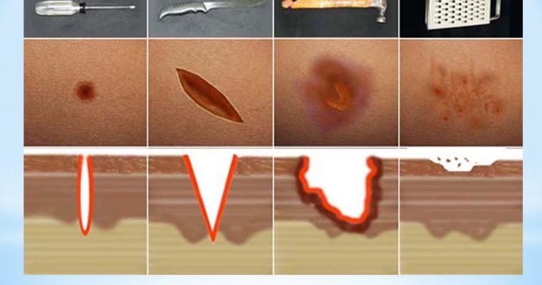 ¿Cuáles son los tipos de heridas que existen?